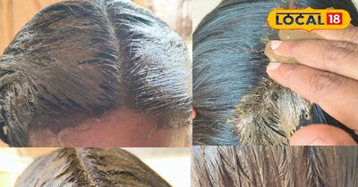 बाल होंगे नरम, चमकदार और डैंड्रफ से मिलेगा छुटकारा, आजमाइए ये घरेलू नुस्खा 