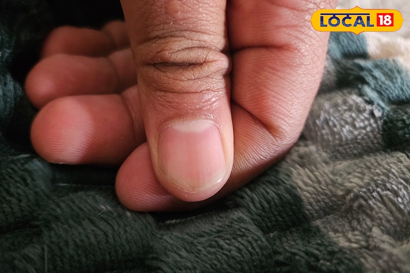 নখের সাদা দাগের কারণ 