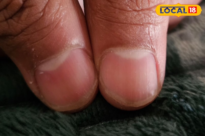 নখের সাদা দাগের কারণ 
