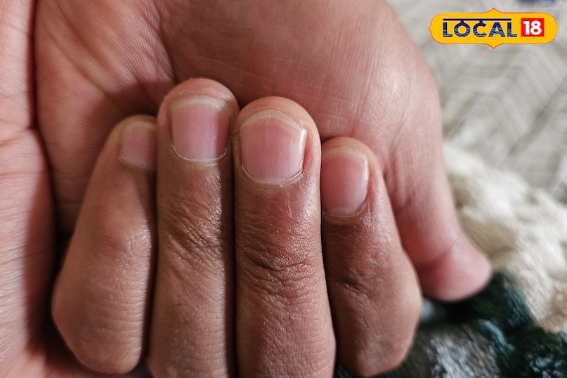 নখের সাদা দাগের কারণ 