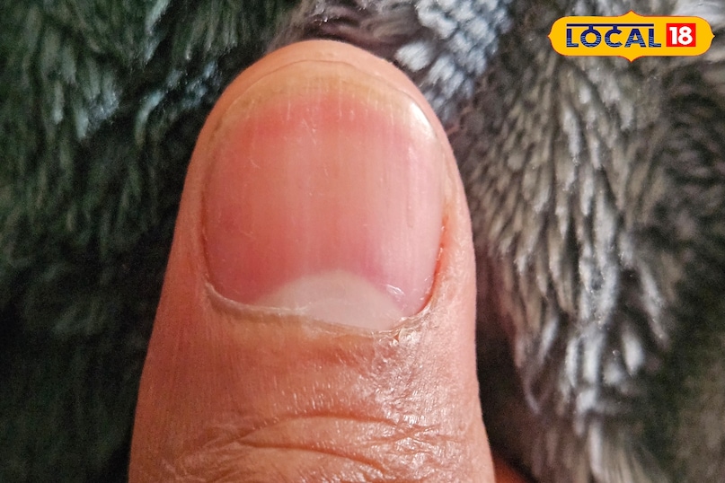 নখের সাদা দাগের কারণ 