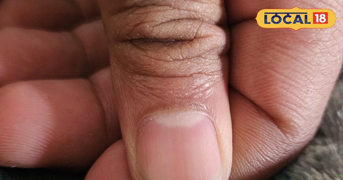 क्या आपके नाखूनों पर भी हैं सफेद धब्बे? जानें कब हैं ये नॉर्मल और कब है बीमारी का संकेत