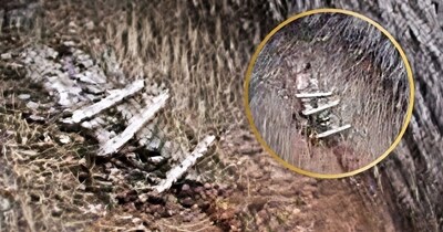 नवादा में घायल युवक के सिर पर स्टेपलर पिन