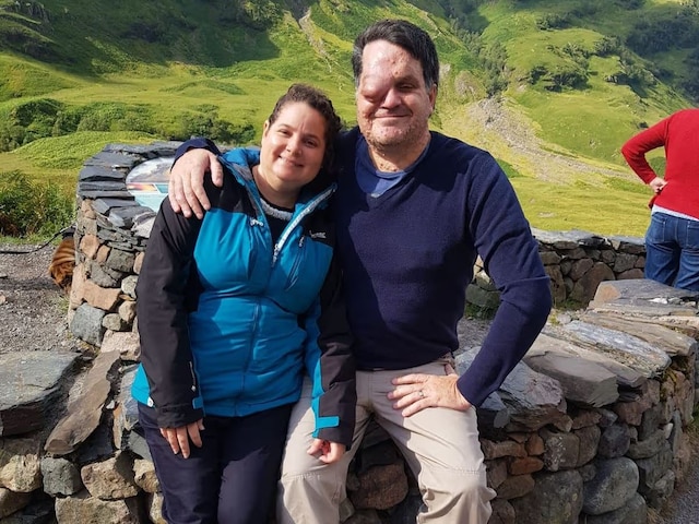 Rare disease took away one eye, people used to call him 'creepy demon', now this person...