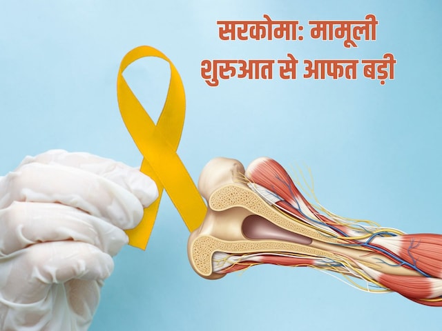 সারকোমা কী, হাড় ও পেটের ব্যথা নিয়ে শুরু হওয়া গল্প কীভাবে ক্যান্সারে পরিণত হয়? 