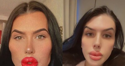 सोफिया लिप्स का कहना है कि फिलर हटवाने का बाद उन्हें उनका चेहरा बिल्कुल पसंद नहीं आ रहा है.