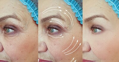 Poor Sleep Causing Wrinkles? Revitalize Skin with These Ayurvedic Tips!