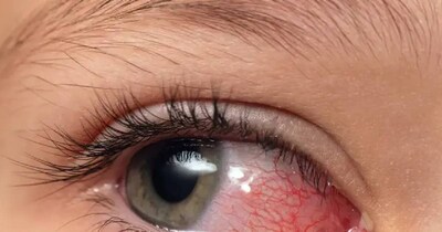 कंजंक्‍ट‍िवाइट‍िस का है आयुर्वेद में सस्‍ता इलाज, जानें क्‍या? 