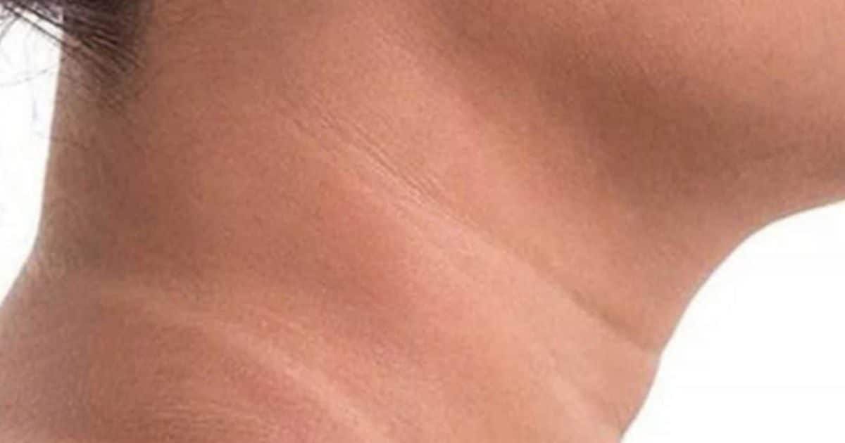 गर्दन का कालापन किन बीमारियों का संकेत? घरेलू उपचार से भी न हो ठीक तो जरूर चेक करवाएं ये च