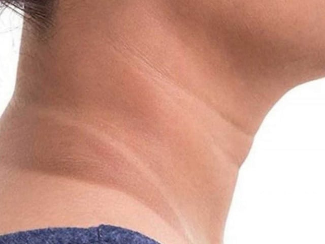 Blackness of neck is a sign of which diseases? If you don't get relief even with home remedies...