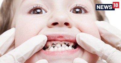 द‍िल्‍ली के स्‍कूली बच्‍चों में दांतों की बीमार‍ियां तेजी से बढ़ रही हैं. 