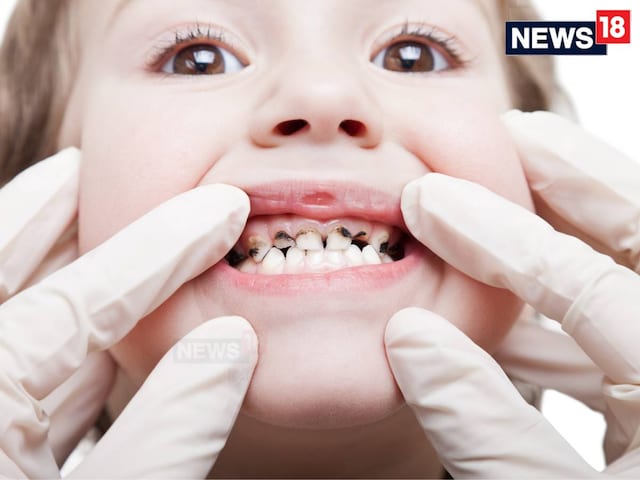 স্কুলের শিশু, অভিভাবকদের দাঁতে এমন জিনিস দেখছেন চিকিৎসকরা... 