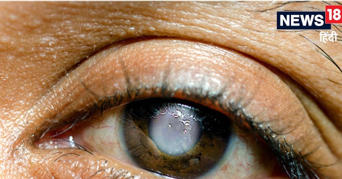 दीमक की तरह आंख को खा जाती है ये बीमारी, भारत में एक करोड़ से ज्यादा लोग शिकार, क्या ग्लूकोमा का है कोई इलाज?