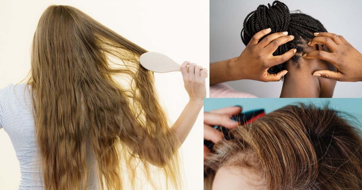 बाल झड़ना और स्कैल्प इंफेक्शन से हैं परेशान? डर्मेटोलॉजिस्ट ने बताए आसान और असरदार उपाय