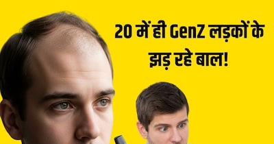 25 साल से कम उम्र के लड़कों के झड़ रहे बाल. 
