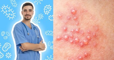 हर्पीज वायरस के कारण चेहरे, होंठ और जननांगों पर छोटे-छोटे दाने निकल आते हैं.