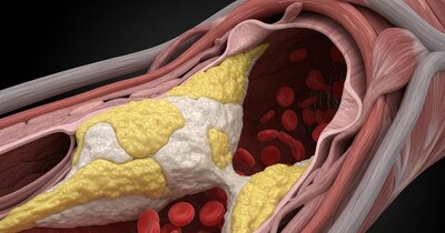4 Ways to Eliminate Bad Fat in Blood Vessels, Prevent Heart Disease