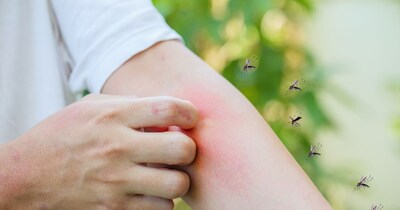 मच्छर काटने के बाद शरीर एक केमिकल छोड़ता है, जिसकी वजह से खुजली होने लगती है.