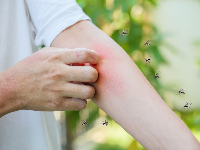 Why mosquito bites itch, Mosquito saliva proteins, Histamine immune response, Skeeter syndrome symptoms, Anti-coagulants in mosquito saliva, How to stop mosquito itch, मच्छर काटने पर खुजली क्यों होती है, हिस्टामाइन के कार्य, मच्छर की लार का विज्ञान, खुजली दूर करने के उपाय