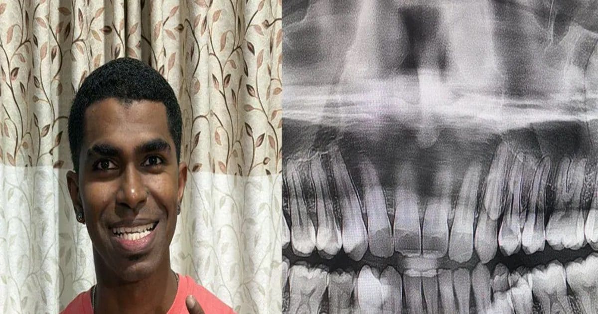 जवानी में उगने लगे शख्स के Extra दांत, मुंह में खुल गई दांतों की दुकान, गिनते-गिनते थक गया डेंटिस्ट!