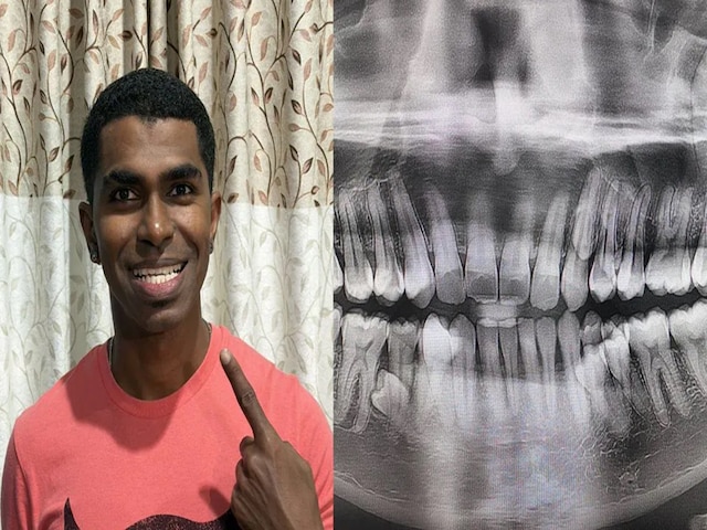 जवानी में उगने लगे शख्स के Extra दांत, मुंह में खुल गई दांतों की दुकान!