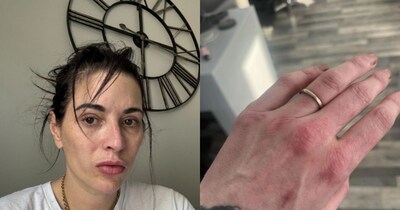 Woman's Skin Burned in Sun, Doctors Dismissed Wounds; Now Terrifying Secret Revealed!