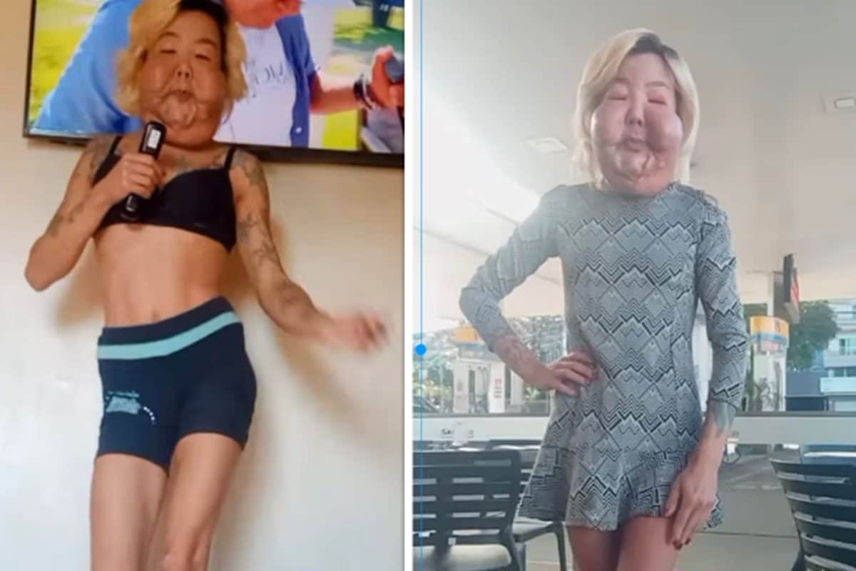 खूबसूरती निखारने के लिए करवाई प्लास्टिक सर्जरी, डॉक्टर्स ने बिगाड़ दिया चेहरा, देखते ही डर जाते हैं लोग