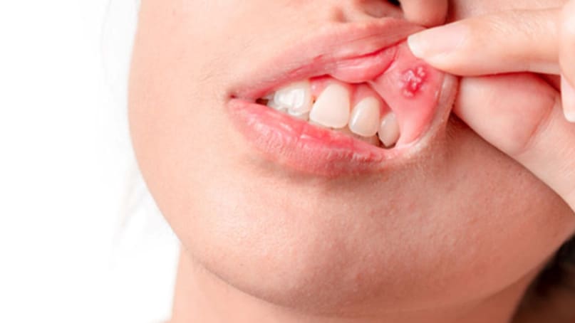 These Everyday Symptoms Could Be Early Signs Of Oral Cancer