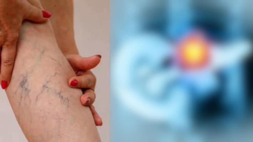 यह कैंसर शुरुआती चरण में अक्सर बिना बड़े लक्षणों के बढ़ता रहता है. इसी वजह से कई मामलों में इसका पता देर से चलता है और इलाज मुश्किल हो सकता है.