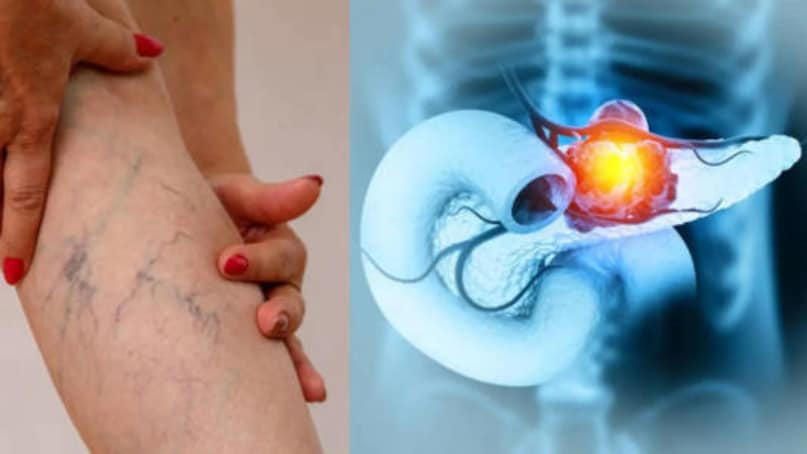 आंखों या त्वचा का पीला पड़ना, भूख कम लगना, तेजी से वजन घटना, पेट दर्द या मल त्याग में बदलाव जैसे संकेत भी अग्नाशय कैंसर से जुड़े हो सकते हैं.