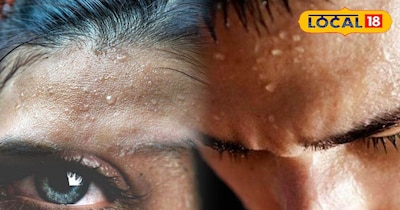 ज्यादा पसीना आना 