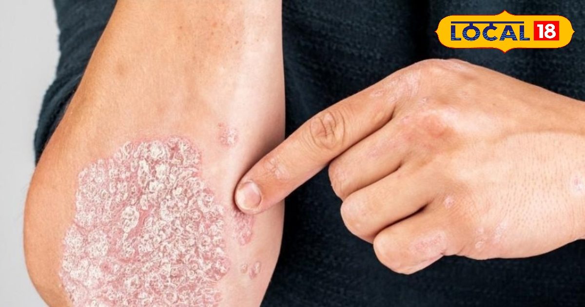 खुजली और लाल चकत्तों का ये है रामबाण इलाज, घर पर बनाएं आयुर्वेदिक क्रीम