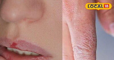 गर्मियों के लिए ब्यूटी टिप्स: रूखे हाथ और होंठ 