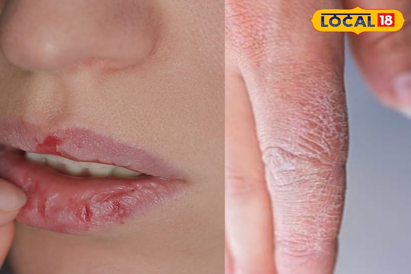 रूखे होठ और हाथ रूखे होठ और हाथ