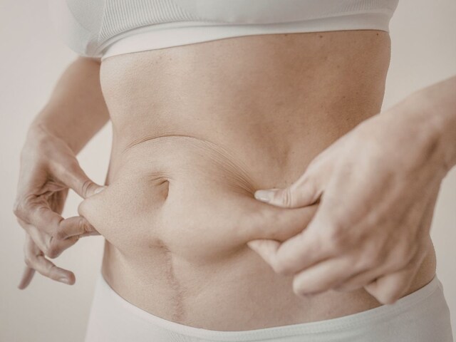 एक बार स्ट्रेच मार्क्स बन जाएं, तो क्या उन्हें हमेशा के लिए हटाया जा सकता है? 