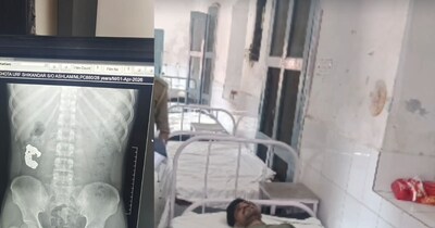 बरेली में चोर ने निगल लिया चांदी का ब्रेसलेट.