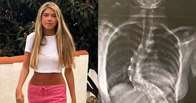 5টি ওপেন-হার্ট সার্জারির পর মেরুদণ্ডের অপারেশনে 3 ইঞ্চি লম্বা হল কিশোরী, মা আবেগপ্রবণ!