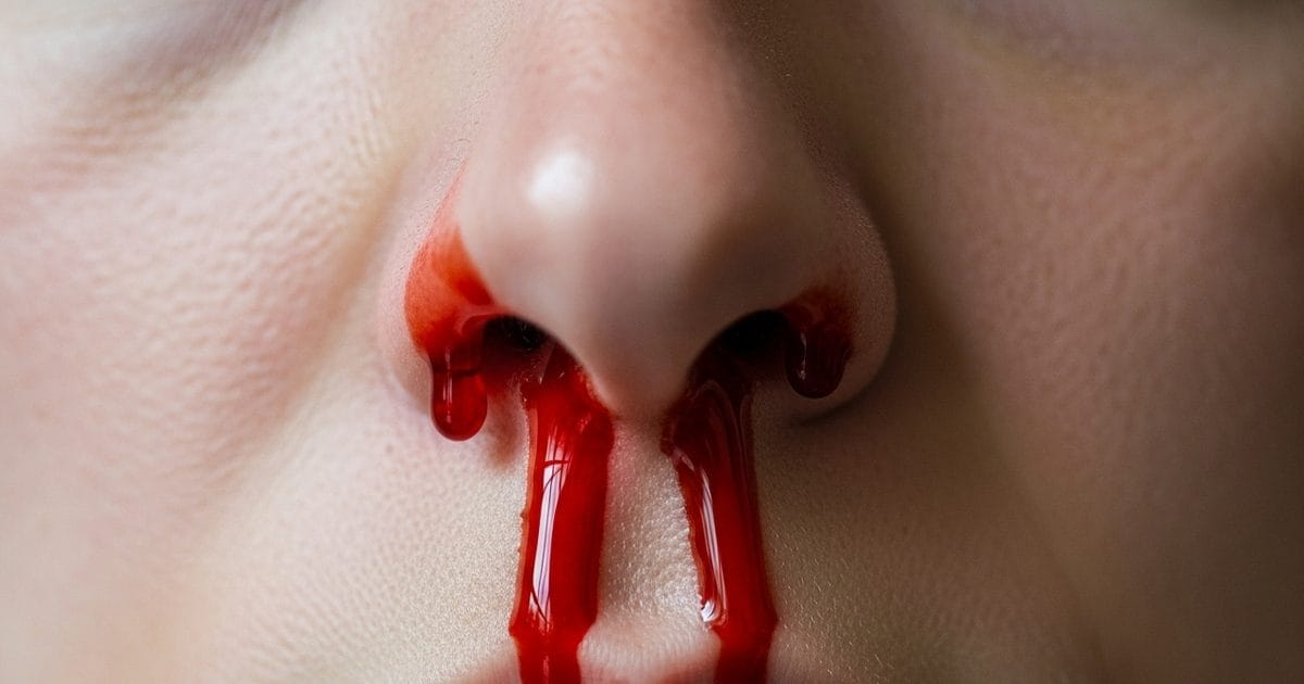 गर्मी में अचानक नाक से खून आता है? जानें कारण, तुरंत राहत के आसान उपाय