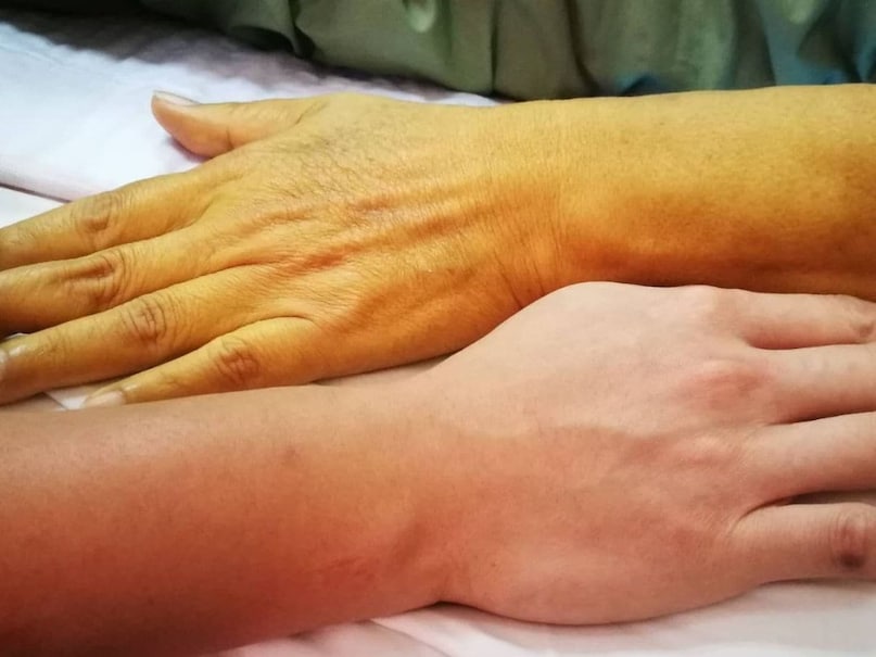 diabetes symptoms, hand color change diabetes symptoms, hand color change