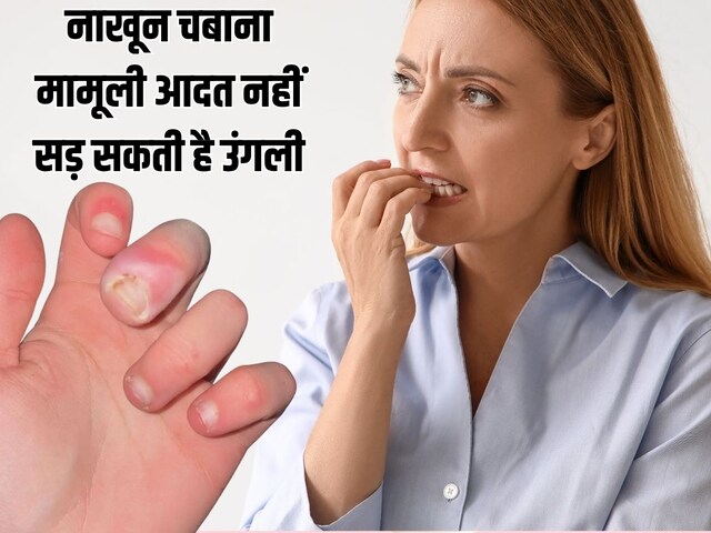 नाखून चबाने की आदत से सड़ने लगी उंगली, 21 साल की लड़की का छलका दर्द