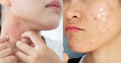 গ্রীষ্মকালীন ত্বকের যত্ন: ত্বককে সুস্থ রাখতে বিশেষজ্ঞের সহজ টিপস!