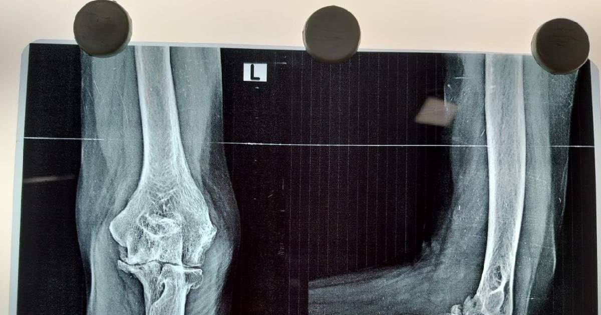 68 साल की मुन्नी देवी की टोटल एल्बो रिप्लेसमेंट से नई जिंदगी