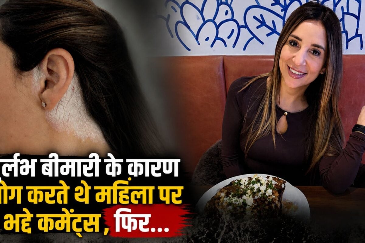 सांप की केंचुली जैसी हुई चमड़ी, तो लोग बुलाने लगे 'इच्छाधारी नागिन', फिर घरेलू नुस्खे से ऐसे दूर हुई बीमारी!