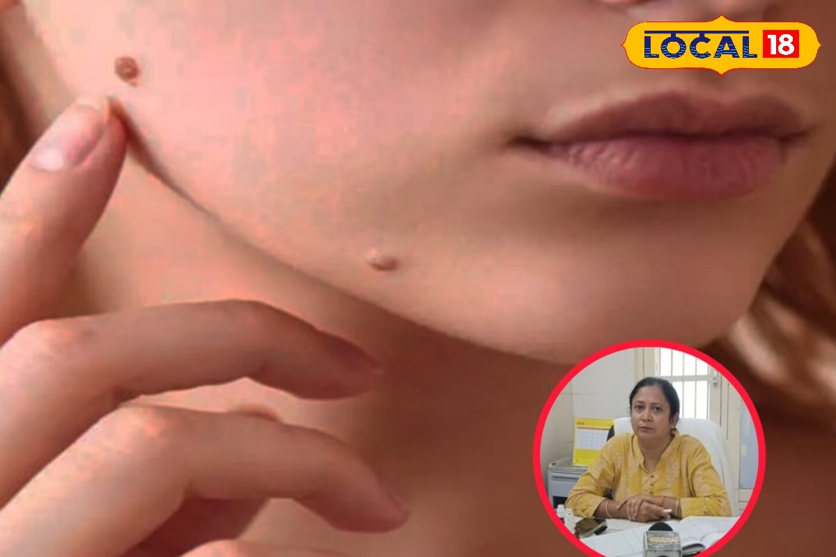मस्सों की समस्या से हैं परेशान? होम्योपैथिक डॉक्टर ने बताए बचाव के साथ घरेलू इलाज