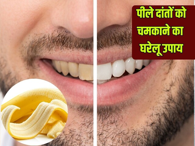  मोती समान चमक उठेंगे पीले-सड़ते दांत, केले के छिलके से करें ये आसान उपाय