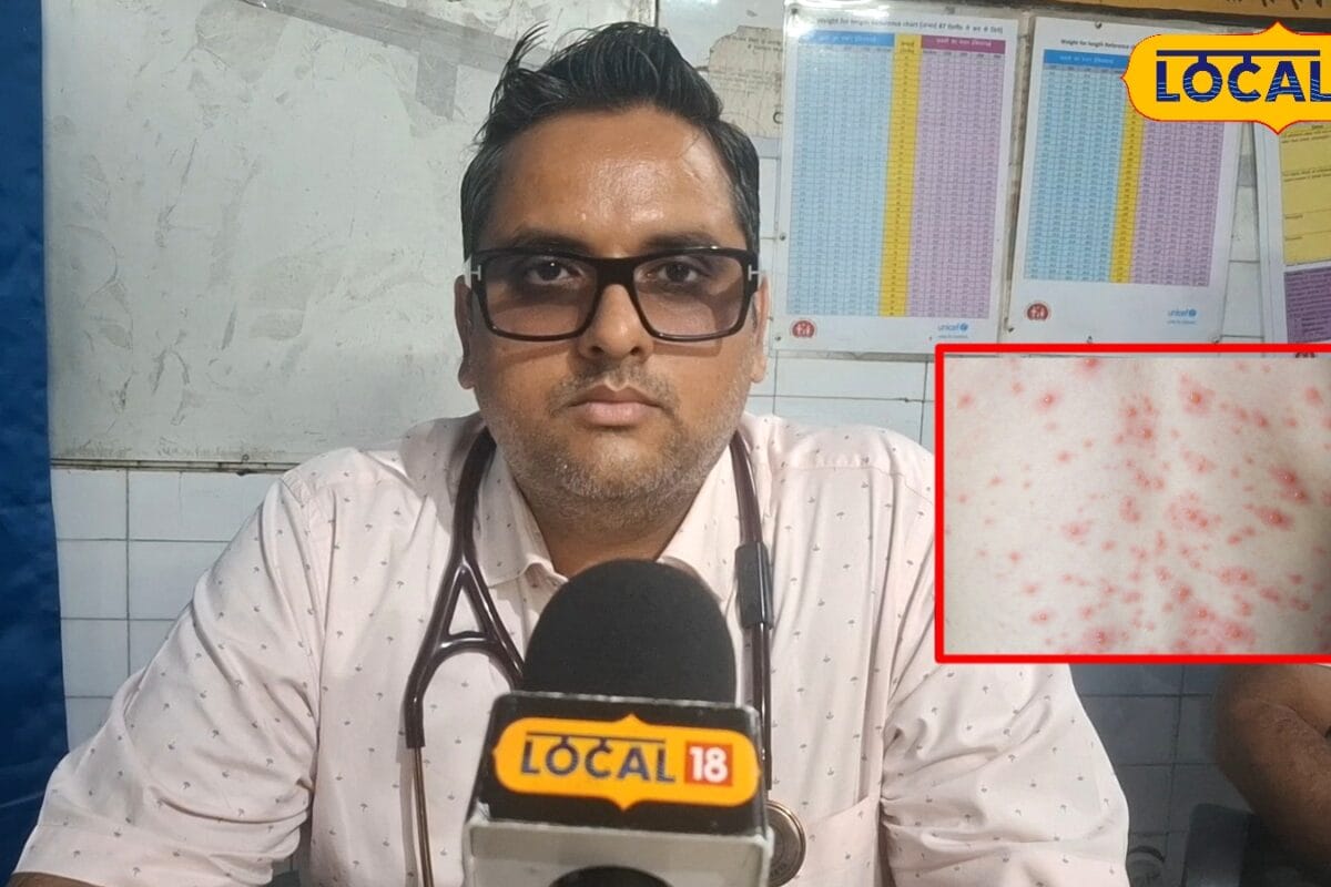 तेज बुखार के बाद निकल रहे हैं छाले हो सकता है चिकनपॉक्स तुरंत करें ये काम