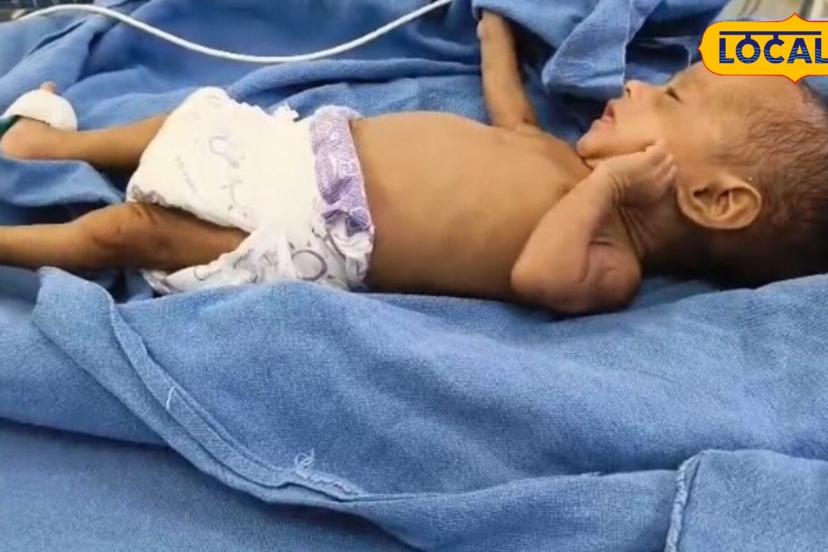 सिर्फ 1% उम्मीद540 ग्राम की बिटिया ने मौत को मात देकर लिया जन्म भागलपुर में मेडिकल साइंस का चमत्कार
