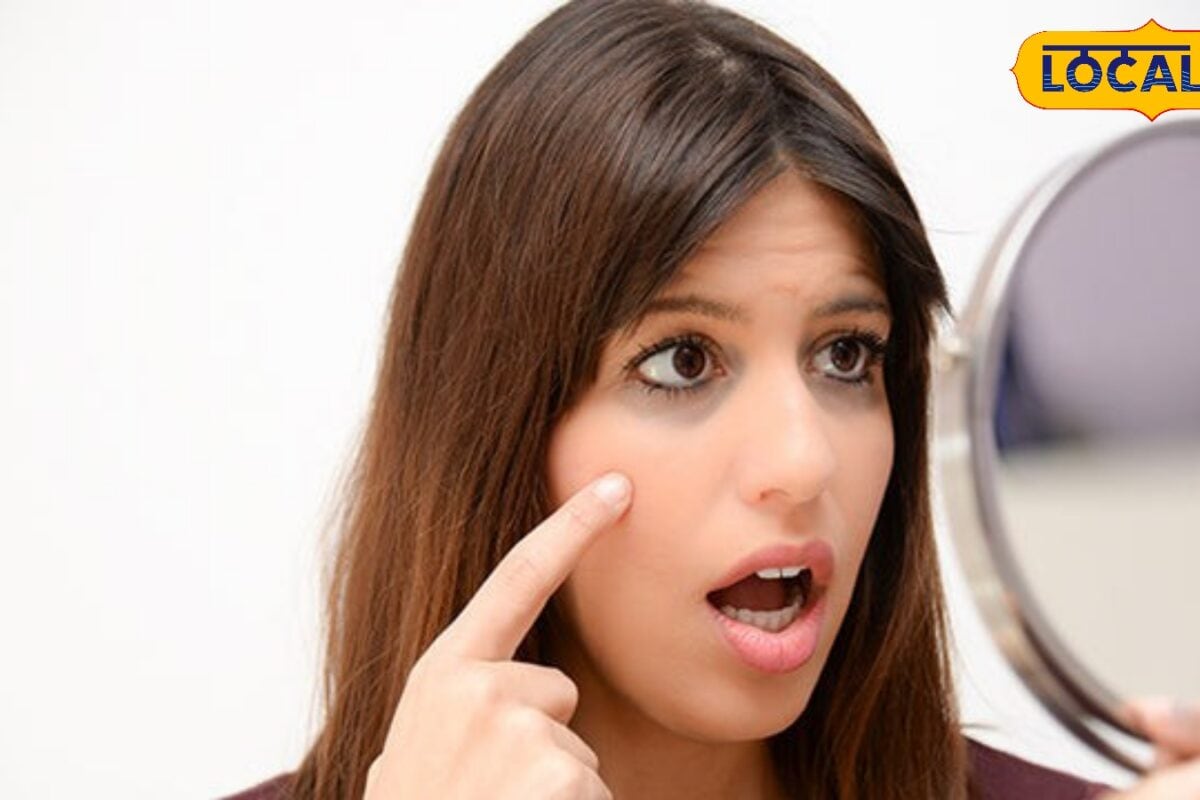 Skincare Tips: चेहरे के काले धब्बे और पिंपल्स से हैं परेशान तो यहां डॉक्टर से जानिए असरदार उपाय