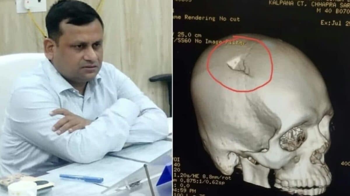 छपरा हिंसा में घायल BDO रितेश कुमार सिंह की क्रिटिकल ब्रेन सर्जरी, पटना के मेदांता में हुआ ऑपरेशन, डॉक्टरों की निगरानी में इलाज छपरा हिंसा में घायल BDO रितेश कुमार सिंह की क्रिटिकल ब्रेन सर्जरी, पटना के मेदांता में हुआ ऑपरेशन, डॉक्टरों की निगरानी में इलाज