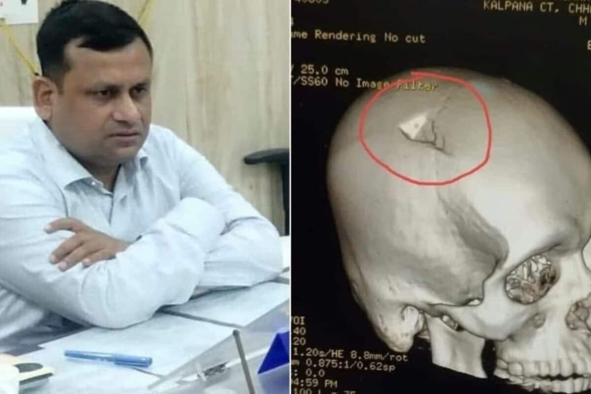 छपरा हिंसा में घायल BDO रितेश कुमार सिंह की क्रिटिकल ब्रेन सर्जरी पटना के मेदांता में हुआ ऑपरेशन डॉक्टरों की निगरानी में इलाज